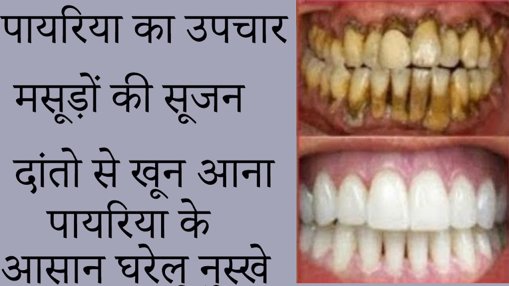 पायरिया का उपचार और मसूड़ों की सूजन के और दांतो से खून आना पायरिया के आसान घरेलू नुस्खे 1 Untitled 1 2