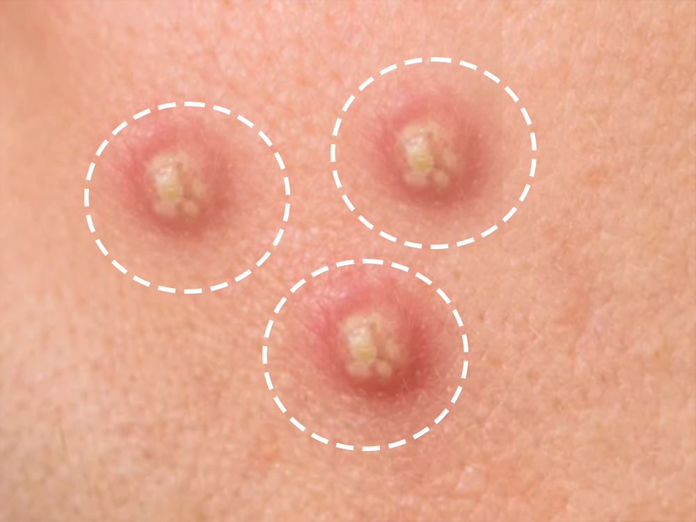 chehare-par-pimpals-kyon-hote-hain